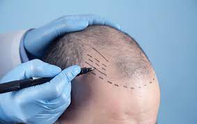 Custom Hair Transplant Solutions in Toronto: Tailoring the Procedure to Your Needs